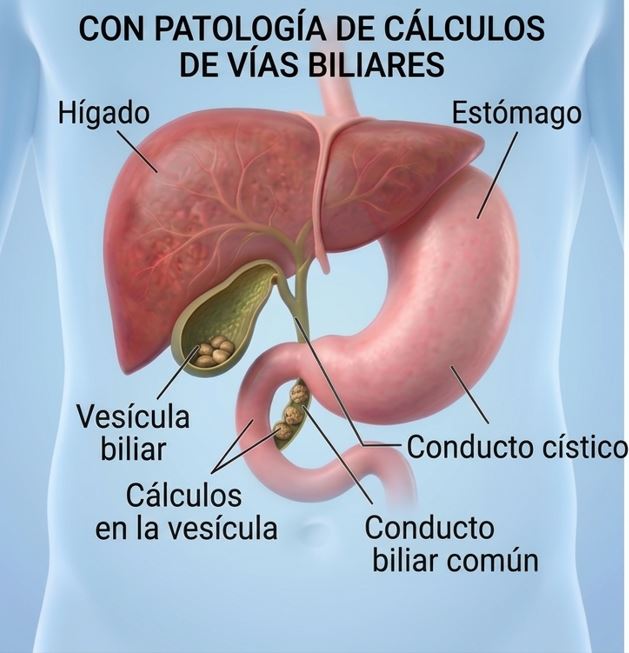 Cálculos en la vías Biliares - Dr- Jorge Higuerey