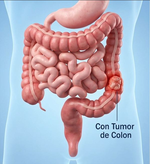Tumor de colon por resección_ Patología_Dr. Jorge Higuerey