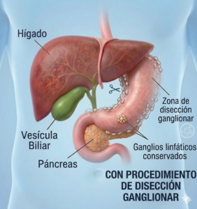 Disección Ganglionar