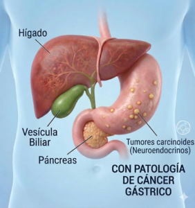 Tumores Carcinoides