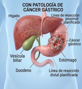 Patología Gástrica