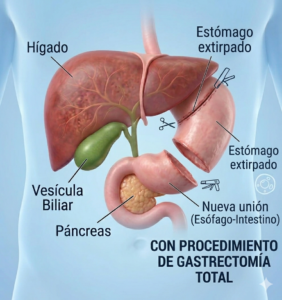 Gastrectomía Total